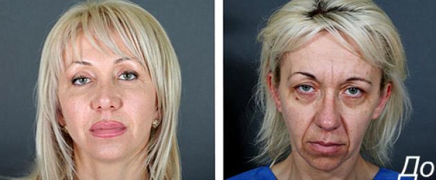 Veido patempimas – apskritas ir be operacijos.  Kaip stangrinti veido odą namuose su nuotraukomis prieš ir po.  Kodėl ir kaip atlikti žiedinį veido pakėlimą: tiriame žvaigždžių pavyzdį Veido pakėlimo operacijų technologijos
