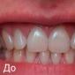 ”Gör-det-själv stjärnleende” eller hur man bleker tänderna hemma Tandblekning hemma