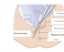 Төрсний дараа оёдол арчлах